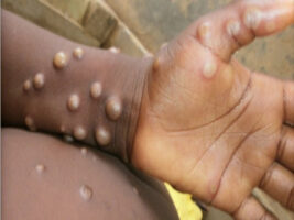 First case of monkeypox detected in Nepal