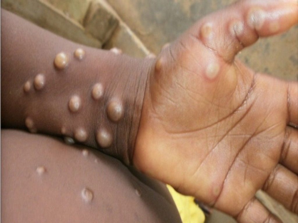 First case of monkeypox detected in Nepal