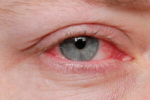 Around 50 percent of patients visiting hospitals found suffering from conjunctivitis
