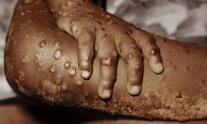 Nepal at risk of Mpox infection, Ministry expects cooperation from civic-level