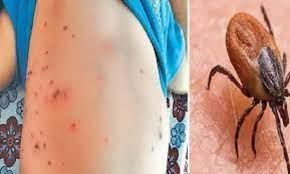 Scrub typhus patients reach 70 in Makwanpur