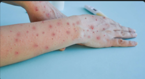 Mpox infected patient gaining recovery